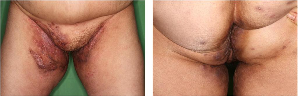 bőrszövetet kímélő excisio elektrosebészeti hámlasztással; TNFα = tumornekrózisfaktor-alfa; TRH = (thyrotropinreleasing hormone) tireotropinfelszabadító hormon; TSH = (thyroid-stimulating hormone)