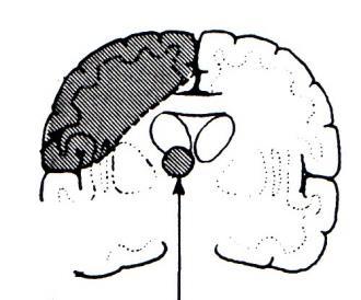 Thalamus és corticalis sensoros syndroma Lateralis thalamus (Dejerine-Roussy sy.): ellenoldali, minden érzéskvalitásra kiterjedő érzészavar; thalamus fájdalom Corticalis sy.