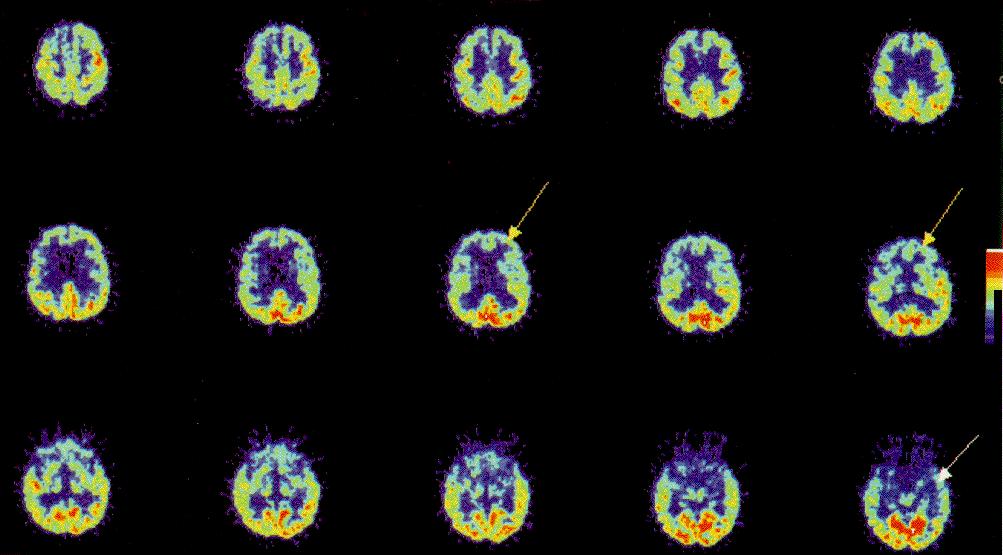 Frontotemporalis dementia Pick-betegség Az atrophia a