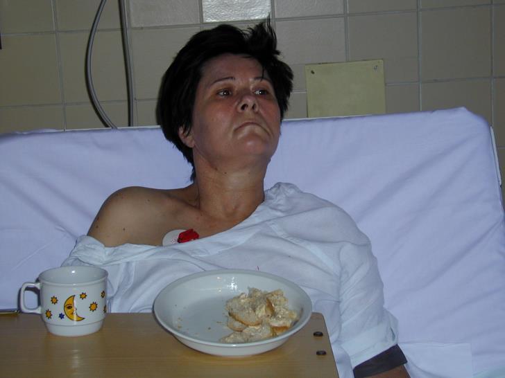 Szimultán ingerek feldolgozásának zavara: a) Neglect:a test két oldalán