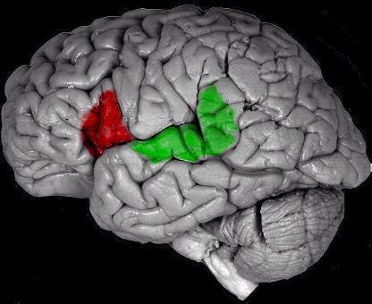 temporalis lebeny és a beszéd Wernicke mező: Szenzoros (folyamatos) aphasia Broca mező: Motoros (nem-folyamatos) aphasia