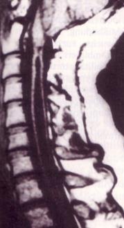 Syringomyelia Cervicalisan a kereszteződő spinothalamicus rostok károsodnak először