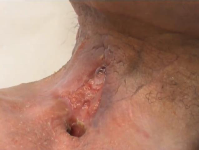 symmetric lipomatosis ). 7.