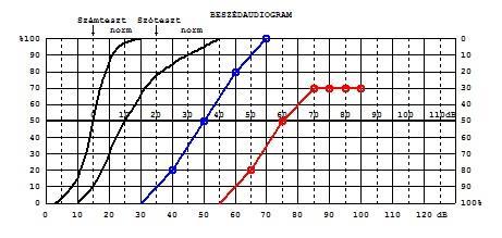 Ábra7.8. Idegi halláscsökkenés diszkriminációs veszteséggel Ábra7.9.