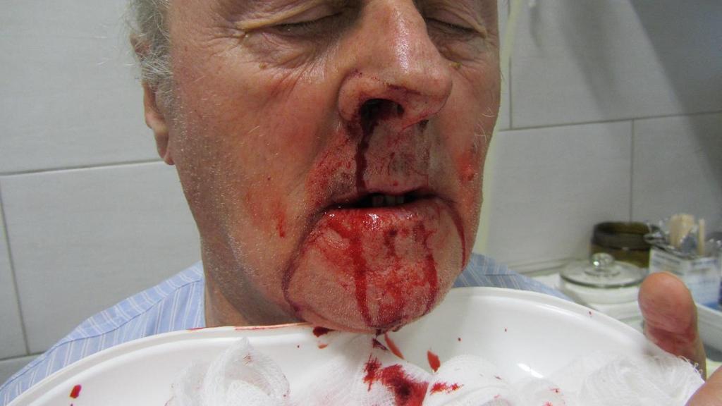 X. Fejezet. Epistaxis (orrvérzés) Az orrvérzés a családorvosi és a fül-orr-gégészeti praxisban is egyaránt előforduló gyakori tünet.