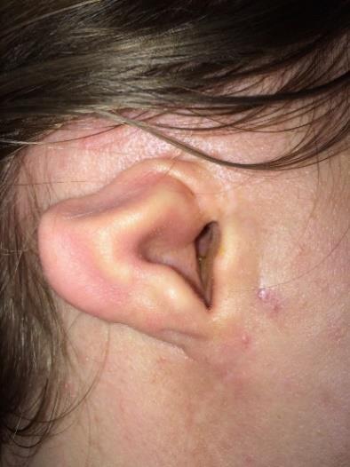 csökevényesen kifejlődött fülkagyló Microtia