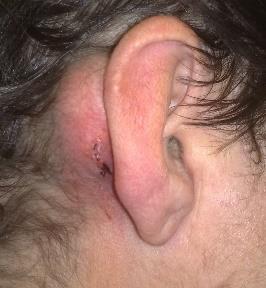 atheroma.