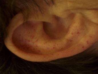 Vascularis malformacio