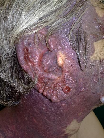 Haemangioma auriculae et