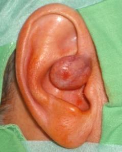 Fibroma. Ábra 1.24.