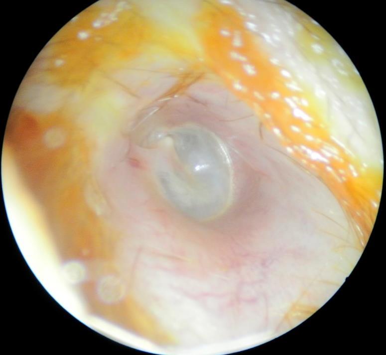 Hallójárat (meatus acusticus externus) normál anatómiája A külső hallójárat nagyjából 25 mm hosszú, laterális kétharmada porcos és hámjának színe általában megegyezik a testfelszín bőrének színével,