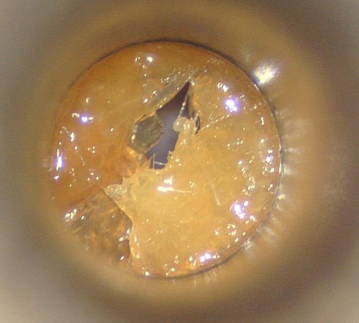 Daganatok folliculitis, furunculus (otitis externa circumscripta