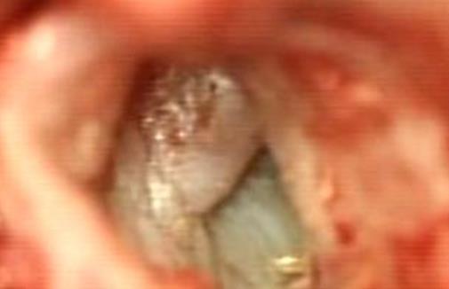 Traumás dobhártya perforáció Iatrogen dobhártya perforáció (paracentézis vagy myringotomia) Iatrogen dobhártya elváltozások Tympanoplastica műtét utáni Daganatok A középfülben elhelyezkedő jó vagy