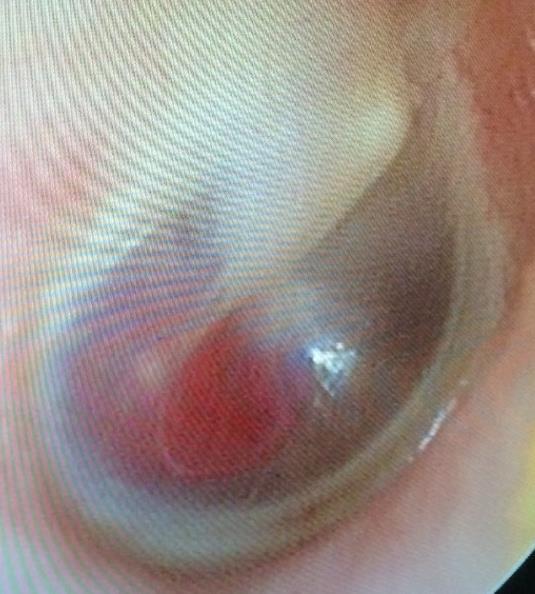 Dobüregi paraganglioma (Dobhártya piros és pulzál) (Ábra 1.46.). Ábra 1.46. Paraganglioma dobüregi lokalizációban.