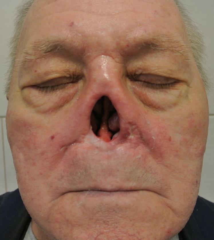 Orr porcos-csontos vázát érintő sérülések /vulnus ruptum, lacerum / (következményes pápaszem haematoma). Orrcsonttörés (fractura nasi)-pl.deviáló és crepitáló orrgyök.
