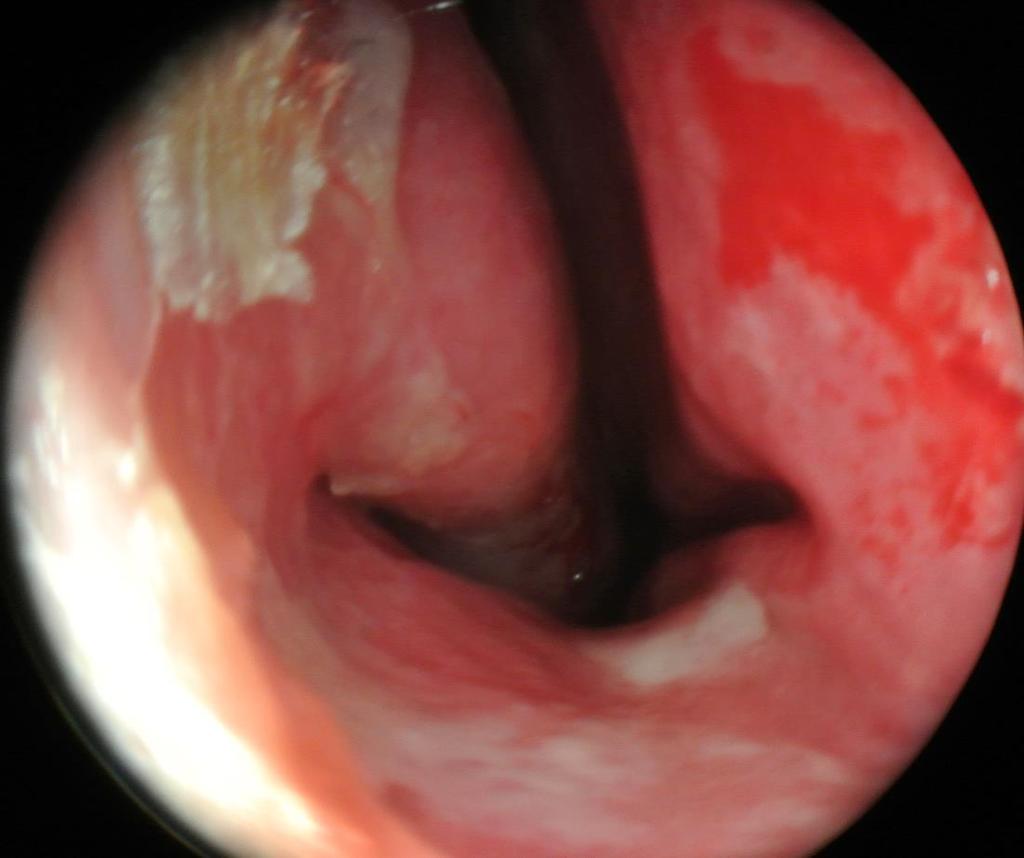folliculitis vestibuli nasi, furunculus nasi akut rhinosinusitis (Ábra 2.13.
