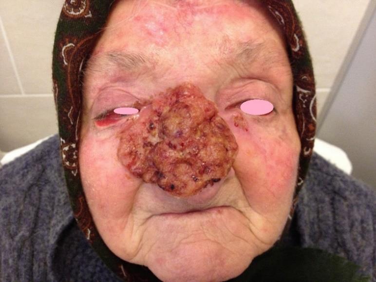 Rhinophyma Planocellularis cc. Basocellularis cc. (Ábra 2.18.