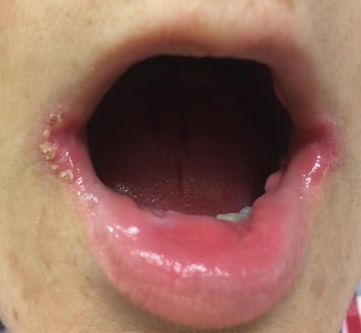 ) angulus infectiosis oris