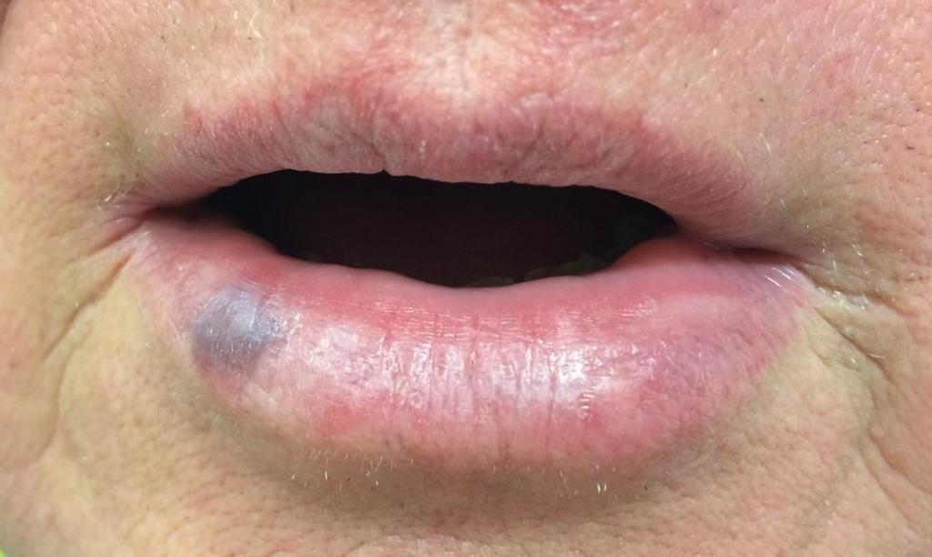 rhagadok - fissurák herpes simplex ekzema
