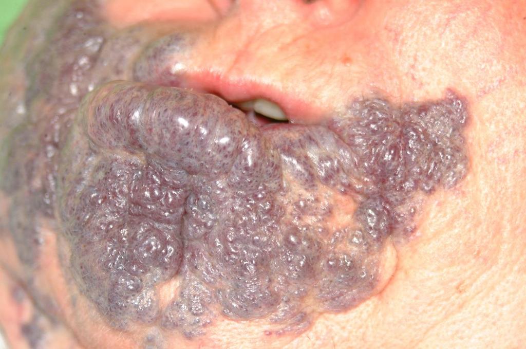Vascularis malformáció.