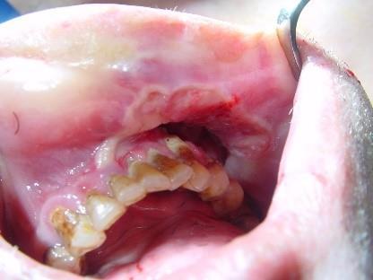 leukoplakia keratosis Gyulladás Malignus daganatok (pl.