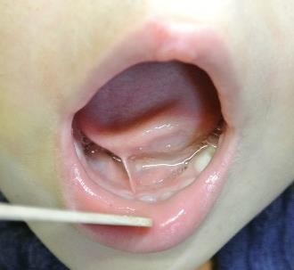 Szájfenék frenulum linguae, (lenőtt nyelv=rövid nyelvfék= frenulum breve) (Ábra 3.12.