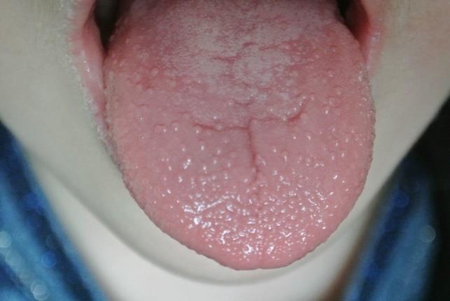Málna nyelv (Skarlát) ( strawberry tongue )