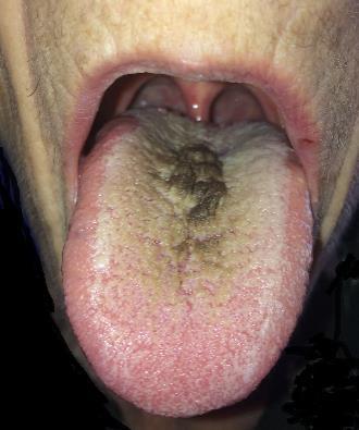 Lingua geographica (térképnyelv) Glossitis granulomatosa (Melkersson Rosenthal szindróma) Fekete szőrös nyelv (túlzott antibiotikum th.