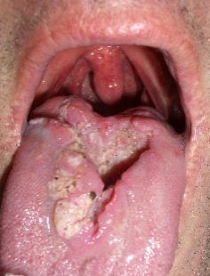 Nyelv oedema (allergia, tumoros folyamat ) (Ábra 3.