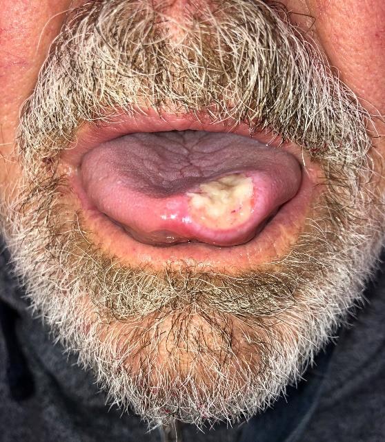 Glossitis (Vitamin A, B hiány- [Pellagra- Niacin])