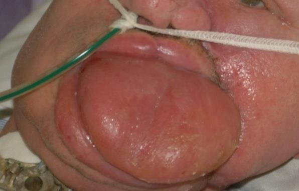 Toxicus stomatitis (bizmut, ólom, higany mérgezés)