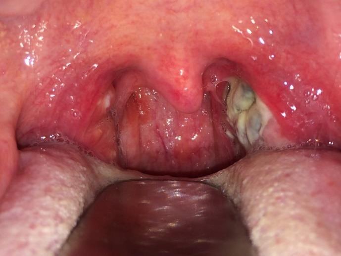Tonsilla palatina A garatmandulák (tonsillæ palatinæ): Gyulladásuk (tonsillitis