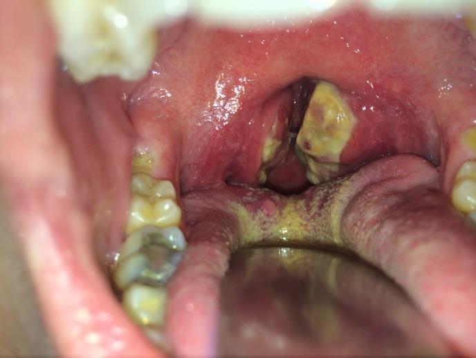 ) Ábra 3.19. Tonsillitis acuta.