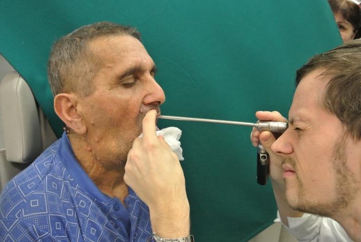 Indirekt gége vizsgálat merev endoscoppal Ábra 4.5. 70 0 merev endoscopos gégevizsgálat. 90 0 vagy 70 0 merev endoscoppal vizsgáljuk a beteget a száján át.