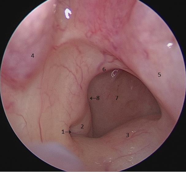 Merev orrendoscopos orrgarat vizsgálat 0 0 vagy 30 0 merev endoscoppal vizsgáljuk a beteget helyi érzéstelenítésben, vagy anélkül.
