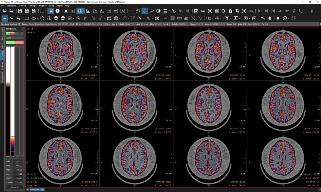 3D Hoffman Fantom MPH Brain Collimátorral leképezve Multi-Modality Display:
