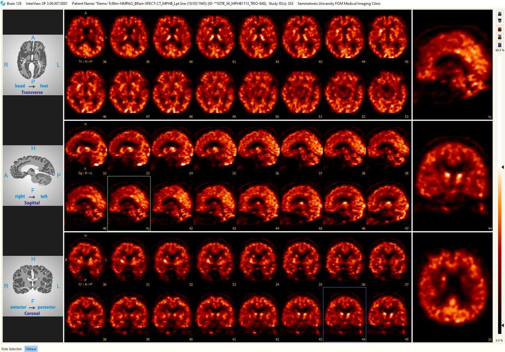 Human Agy Leképezés Tc 99m -HMPAO pharmacon MPH Brain Kollimátor Image Recon.