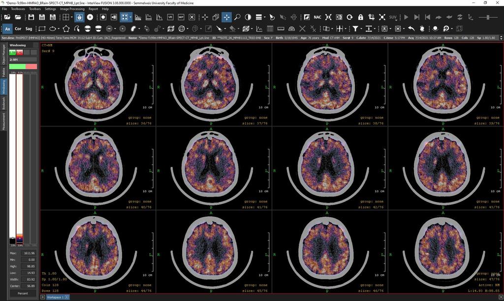 Human Agy Leképezés Tc 99m -HMPAO pharmacon, TRIO MPH Brain kollimátor