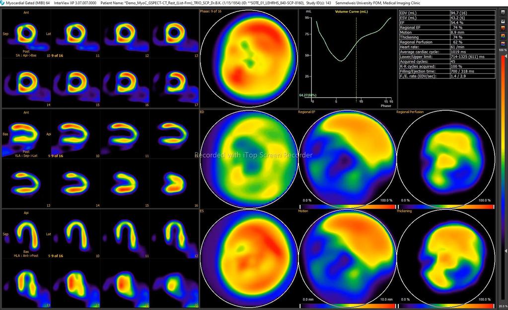 Human Kapuzott Szívizom vizsgálat Tc 99m -MyoView pharmacon parallel Kollimátor Image Recon.