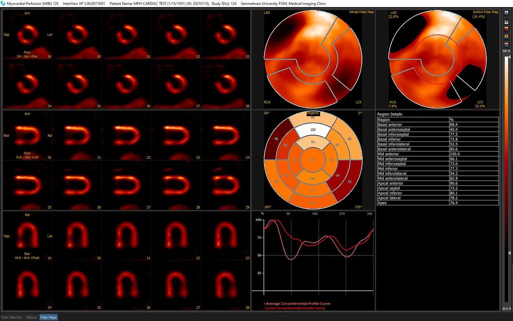 Szívizom Fantom vizsgálat Tc 99m Radio-pharmacon MPH Szív Kollimátor Image Recon.