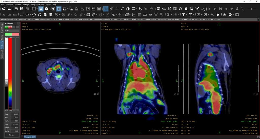 Kutya F 18 -DG PET/CT InterView Fusion,