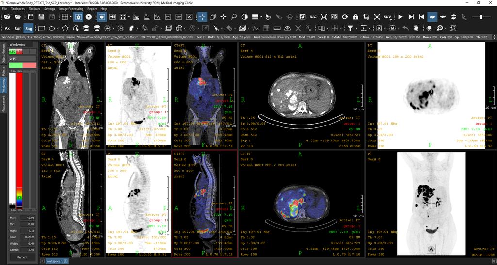 Human F 18 -DG PET/CT Vizsgálat InterView Fusion,