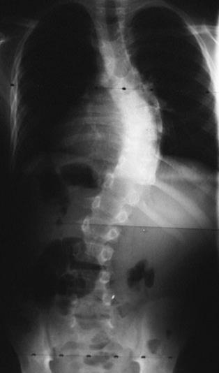 Lumbalis