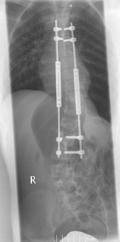 Early onset scoliosis