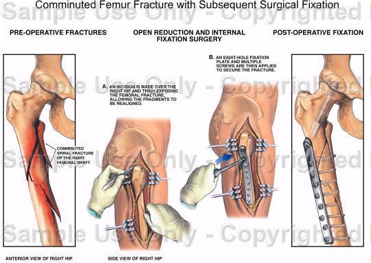 Lemezes OS Indikációk: érsérülés metaphysealis, intraarticularis törések periprotetikus törések Előnyök: