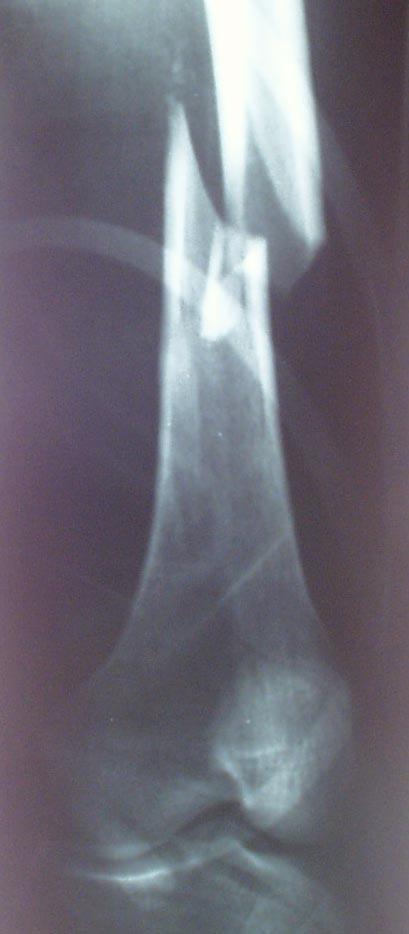 Femur
