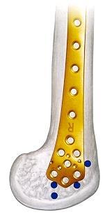LISS: less invasive stabilising system LCP: locking compression plate fixateur interne Indikációk : metaphysis,