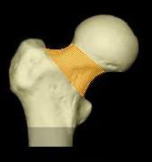 Combnyak törései Medialis: Garden I: valgus beékelt Garden II: elmozdulás nélküli