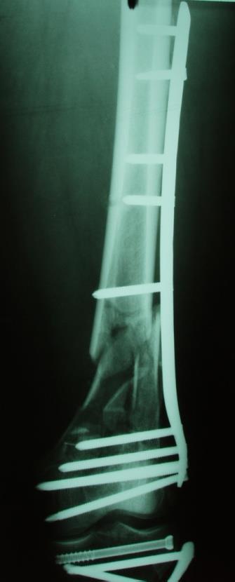 C2 femur