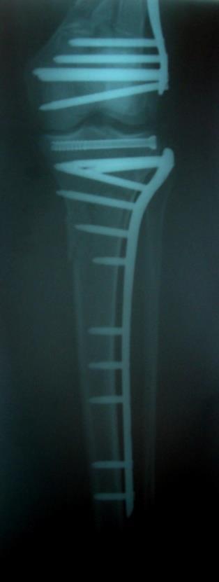 tibia: